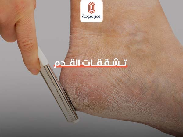 تشققات القدم