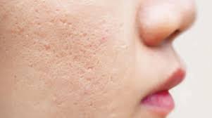 ما هي ندبات حب الشباب؟ أنواعها وأسبابها