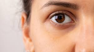 ما هي الهالات السوداء؟ ولماذا تظهر؟