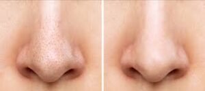 علاجات إزالة الرؤوس السوداء في العيادات التجميلية