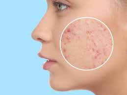 ما هو حب الشباب؟ وما أسباب ظهوره؟