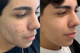 نصائح إضافية عند استخدام ماسك لعلاج حب الشباب