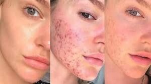 نصائح لمنع ظهور حب الشباب مجددًا