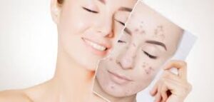 علاج حب الشباب بالطرق الطبيعية والمنزلية