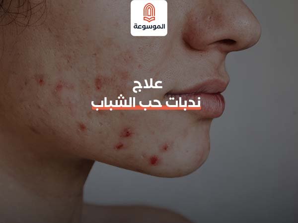 علاج ندبات حب الشباب