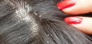 تفسير حلم نزع القمل وقتله للمتزوجة