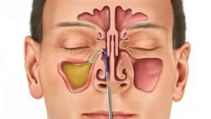أسباب التهاب الجيوب الأنفية