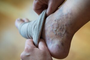 الأسباب الشائعة لظهور العروق الزرقاء