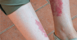 الأدوية المستخدمة لعلاج البقع الحمراء