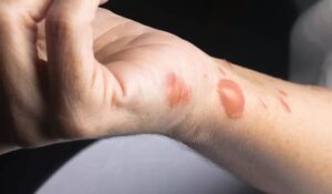 أفضل المراهم لعلاج حروق الزيت