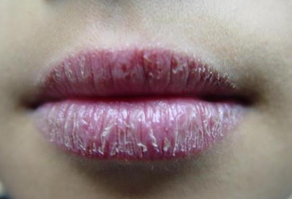 لماذا قد يسبب الفازلين جفافًا للشفايف؟