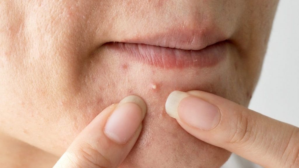 أفضل العلاجات الطبيعية للتخلص من الحبوب تحت الجلد