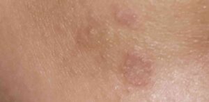 الوقاية من ظهور البقع الحمراء