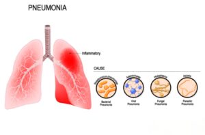 الوقاية من التهاب الشعب الهوائية