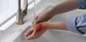 الإسعافات الأولية لحروق الدرجة الأولى