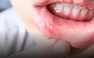 دور النظام الغذائي في الوقاية من فطريات الفم