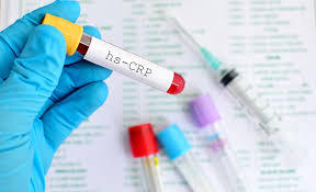 أسباب إجراء تحليل CRP