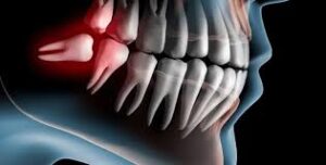 كيفية التعامل مع النزيف بعد الخلع