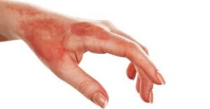 متى يجب زيارة الطبيب بعد الحروق