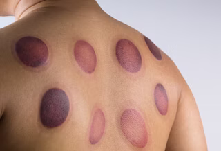 طرق الحجامه المستخدمة لعلاج الحسد