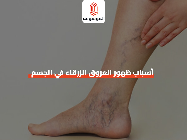 أسباب ظهور العروق الزرقاء في الجسم