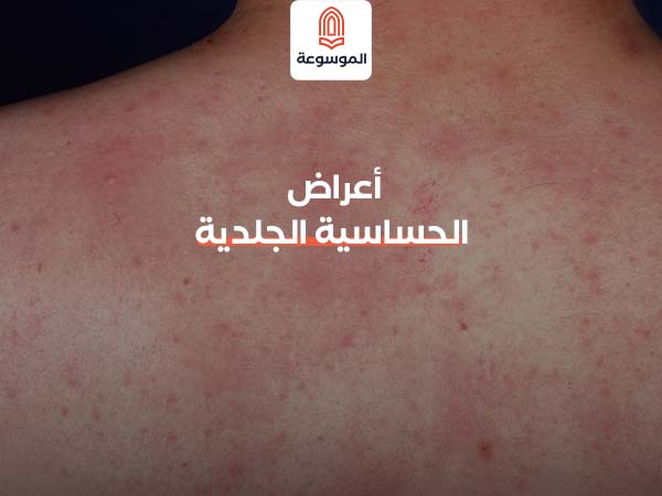 أعراض الحساسية الجلدية