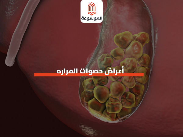 أعراض حصوات المراره