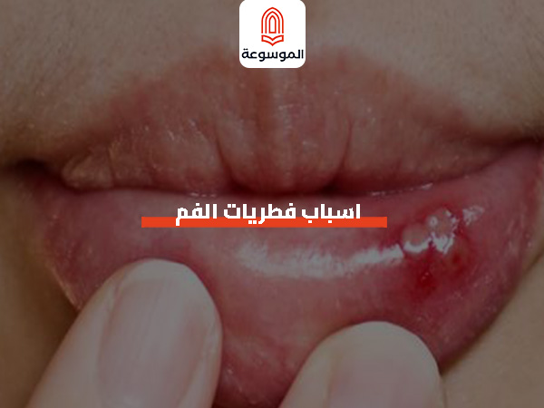 اسباب فطريات الفم