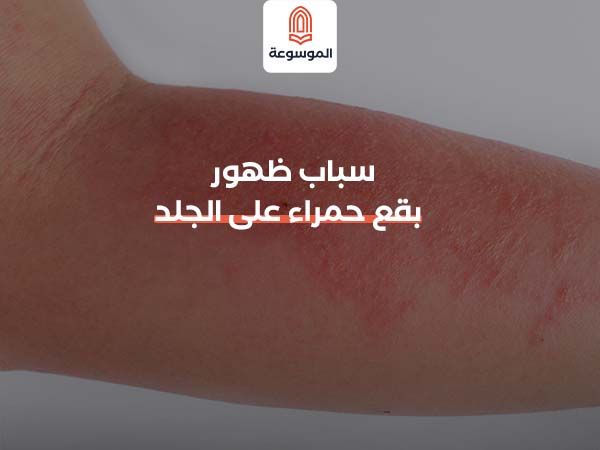 اسباب ظهور بقع حمراء على الجلد