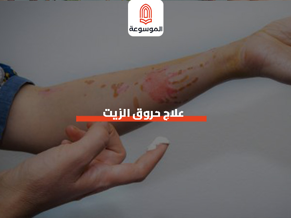 علاج حروق الزيت