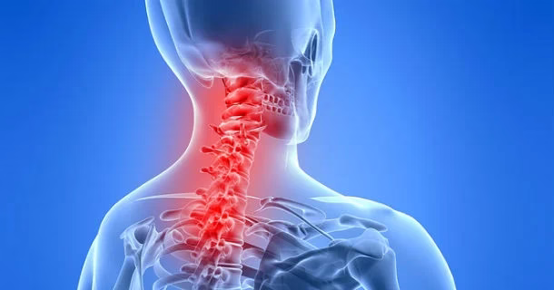 علاج آلام الفقرات العنقية