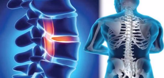 الأمراض الشائعة التي تصيب العمود الفقري