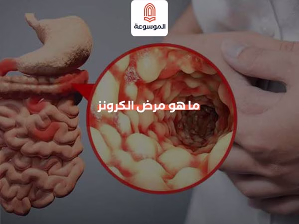ما هو مرض الكرونز