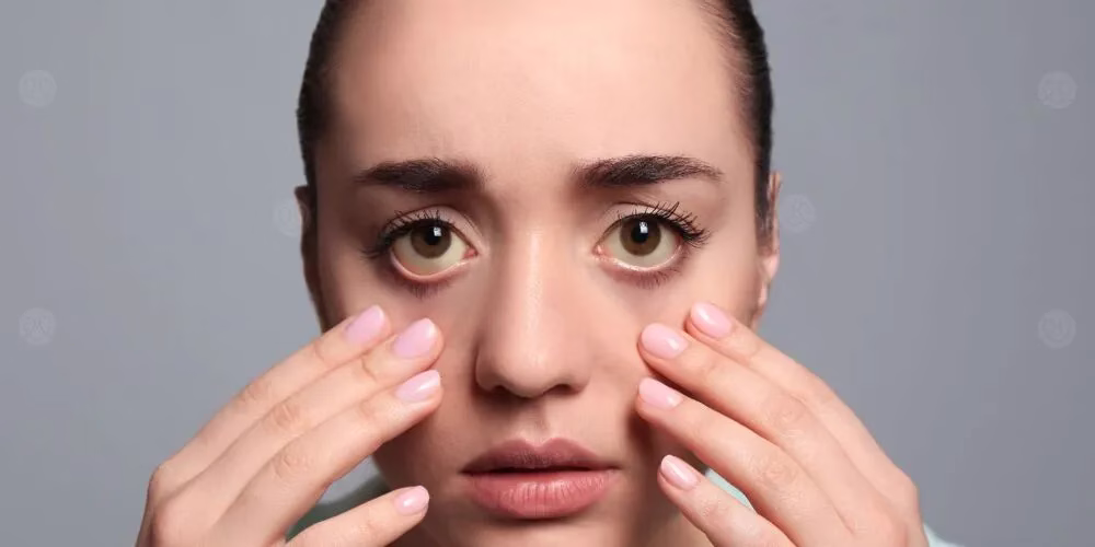 تأثير التهاب الكبد على بياض العين