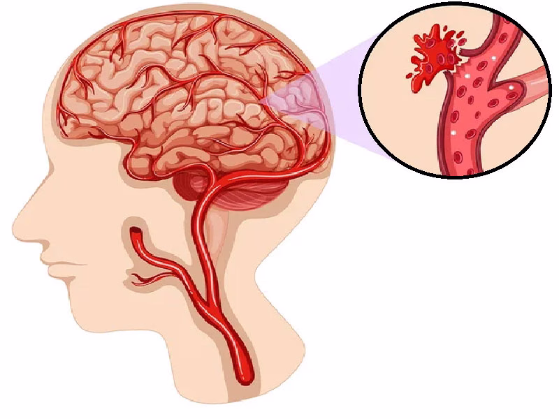طرق تشخيص نزيف المخ والفحوصات اللازمة
