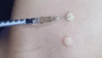 الآليات العلاجية لسم النحل في الجسم