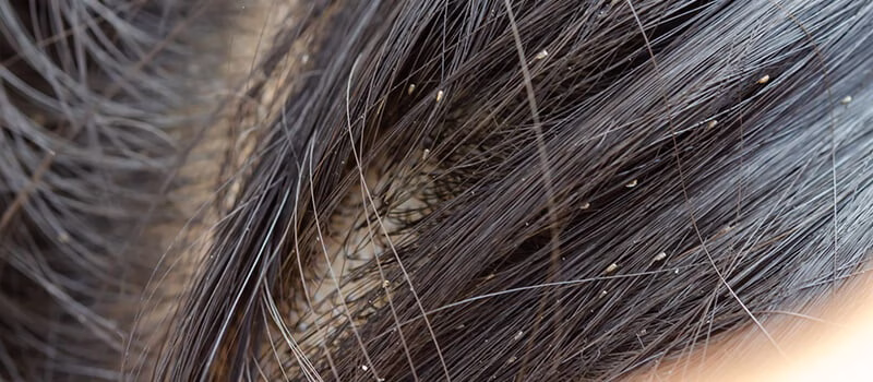 تفسير رؤية القمل في شعر شخص آخر للعزباء