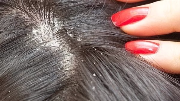 تأويل حلم القمل في الشعر حسب ابن سيرين