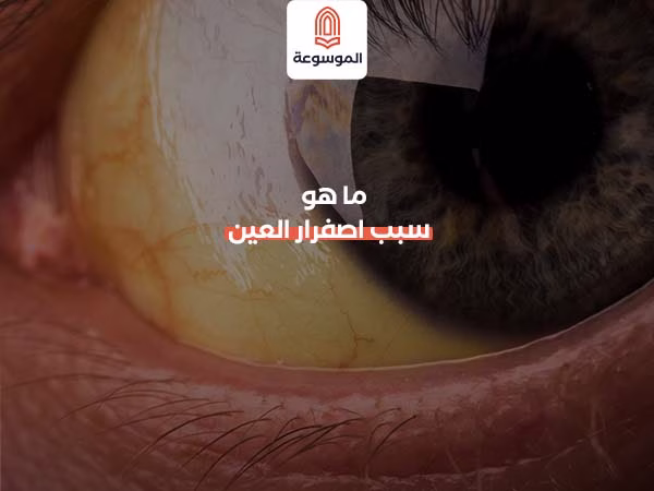 ما هو سبب اصفرار العين